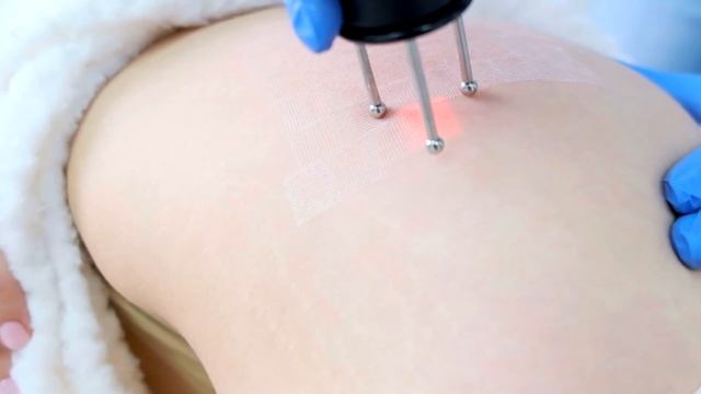 Лазерная шлифовка тела на аппарате Dermablate MCL 31 Asclepion в Honest Beauty Clinic смотреть онлайн