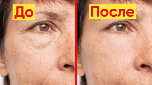 МОЩНОЕ СРЕДСТВО ОТ ПИГМЕНТАЦИИ БЫСТРО СОТРЕТ ПЯТНА!