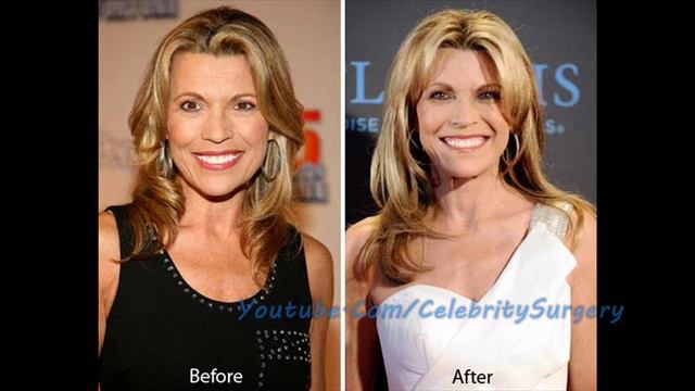 Vanna White Plastic Surgery Before and After смотреть онлайн