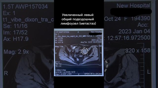 Увеличенный левый общий подвздошный лимфоузел (метастаз) смотреть онлайн