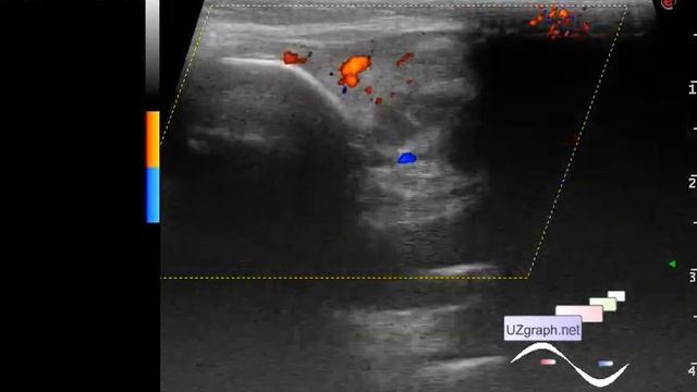 Pediatric Soft tissue ultrasound - Neck lesion смотреть онлайн