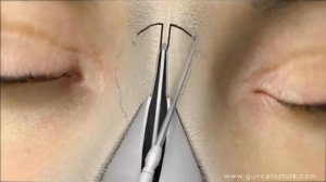 Ринопластика (Операция на носу) Анимационное видео - доктор Гунцель Озтурк