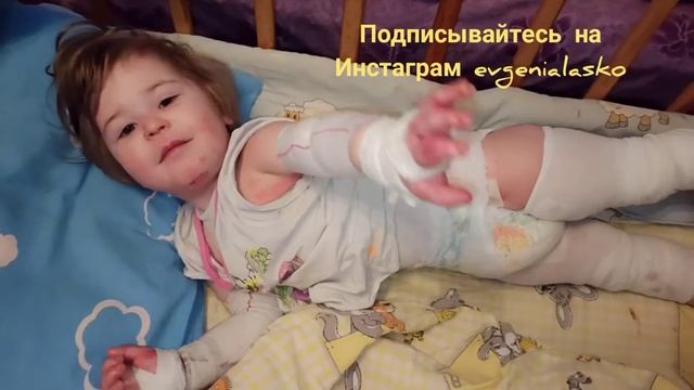 Крем Гехт в действии. Большая рана у ребенка с синдромом бабочки. смотреть онлайн