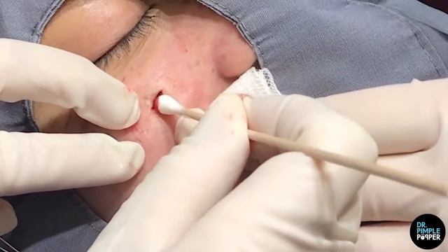 A Surprise Projectile Pilar Cyst смотреть онлайн