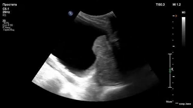 УЗИ. Аденома простаты. Prostate adenoma. BPH смотреть онлайн