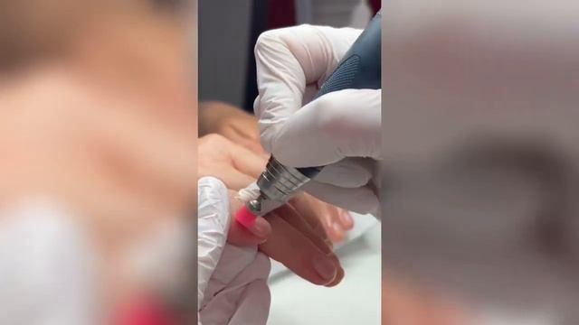 Боковой онихолизис. Восстановление ногтевых пластин. смотреть онлайн