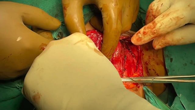 Total thyroidectomy with central lymph node dissection смотреть онлайн
