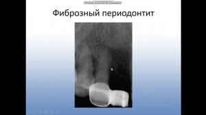 Лучевая диагностика периодонтита и остеомиелита