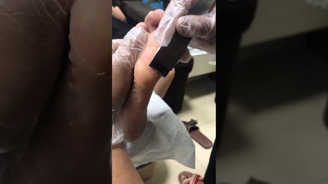 It will be like this if you wear too many high shoes, the pedicure master treats it【Foot Scalpel】 смотреть онлайн