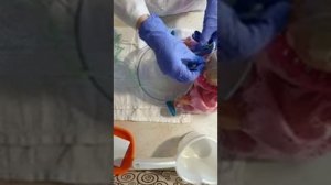 Промывание желудка толстым зондом