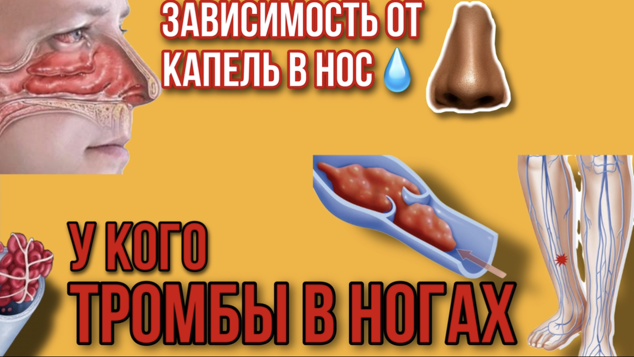 Почему и у кого образуются ТРОМБЫ в ногах? Зависимость от назальных капель. Как от неё избавиться? смотреть онлайн