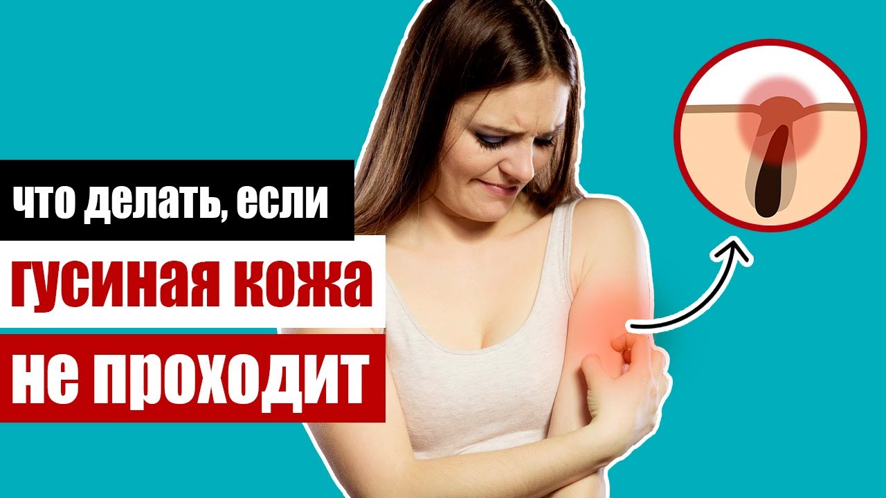 Гусиная кожа - что делать если пупырышки не проходят