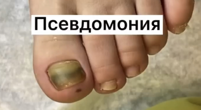 Псевдомония смотреть онлайн