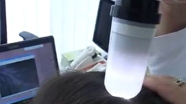 Alopecija areata - opadanje kose смотреть онлайн