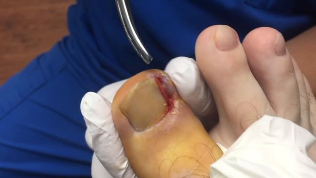 Old Ingrown Nail. Ingrown Nail Removal. смотреть онлайн
