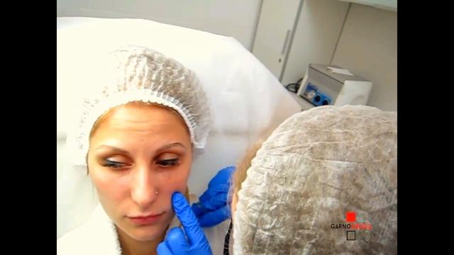 restylane vital light для работы с периорбитальной зоной смотреть онлайн