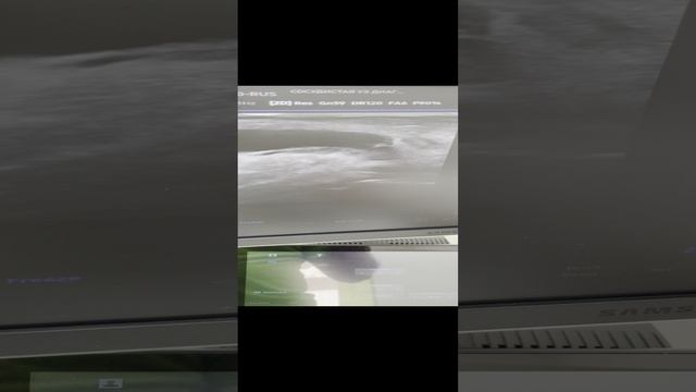 Боли в ногах. При обследовании сосудов выявили гонартроз. Узи сосудов. Узи суставов. Флеболог Москва смотреть онлайн