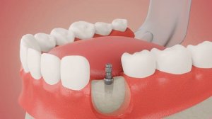 Имплантация зубов - как происходит этот процесс. Имплантация зубов в Москве.