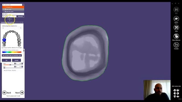 Insertion Correction in exocad смотреть онлайн