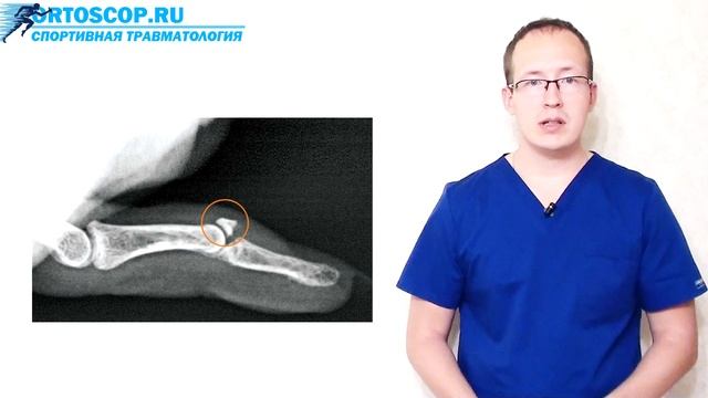 ПОЧЕМУ НЕ ВЫПРЯМЛЯЕТСЯ ПАЛЕЦ ПОСЛЕ ТРАВМЫ? ОТРЫВ СУХОЖИЛИЯ РАЗГИБАТЕЛЯ смотреть онлайн