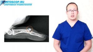 ПОЧЕМУ НЕ ВЫПРЯМЛЯЕТСЯ ПАЛЕЦ ПОСЛЕ ТРАВМЫ? ОТРЫВ СУХОЖИЛИЯ РАЗГИБАТЕЛЯ
