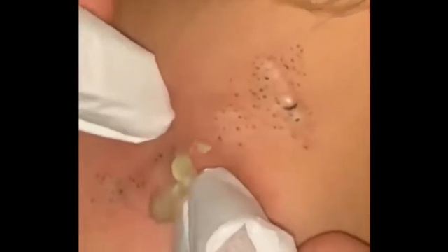 Big Blackheads залипательное видео 2022, черные точки давим