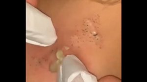 Big blackheads залипательное видео 2022, черные точки давим