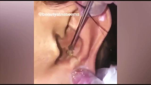 Выдавливание чёрных точек НОВОЕ! Удаление чёрных точек за ухом. Чистка лица. Прыщи - выдавливание! смотреть онлайн