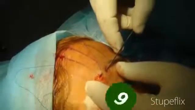 Нитевой лифтинг бровей. Золотые нити. смотреть онлайн