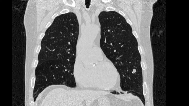 Как познать природу очаговой тени в легком не применяя контраст.