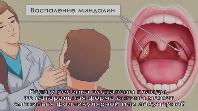 Покраснение гланд и воспаление миндалин у ребенка смотреть онлайн