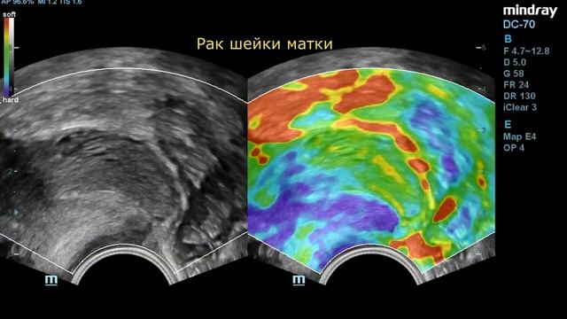 Компрессионная эластография в МЦ Сонодин смотреть онлайн