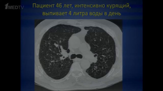 Проблема диагностики диффузных паренхиматозных заболеваний легких смотреть онлайн
