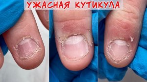 Ужасная кутикула и заусенцы / Расковырял пальцы
