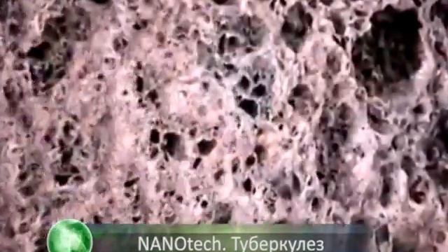 NANOtech 62 Туберкулез смотреть онлайн