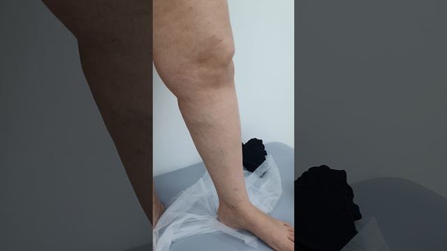 Результат Операции лечения варикоза. Как лечить варикоз? Флеболог. Флеболог Москва смотреть онлайн