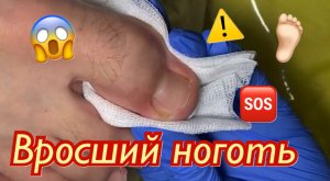 Вросший ноготь⚠️?❗️??