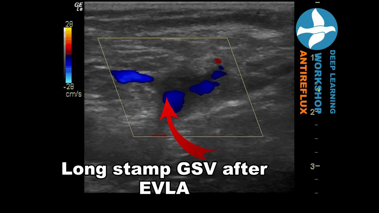 Long stamp GSV after EVLA смотреть онлайн