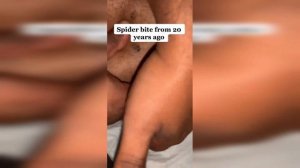 подборка выдавливания прыщей 14 II выдавливания прыща