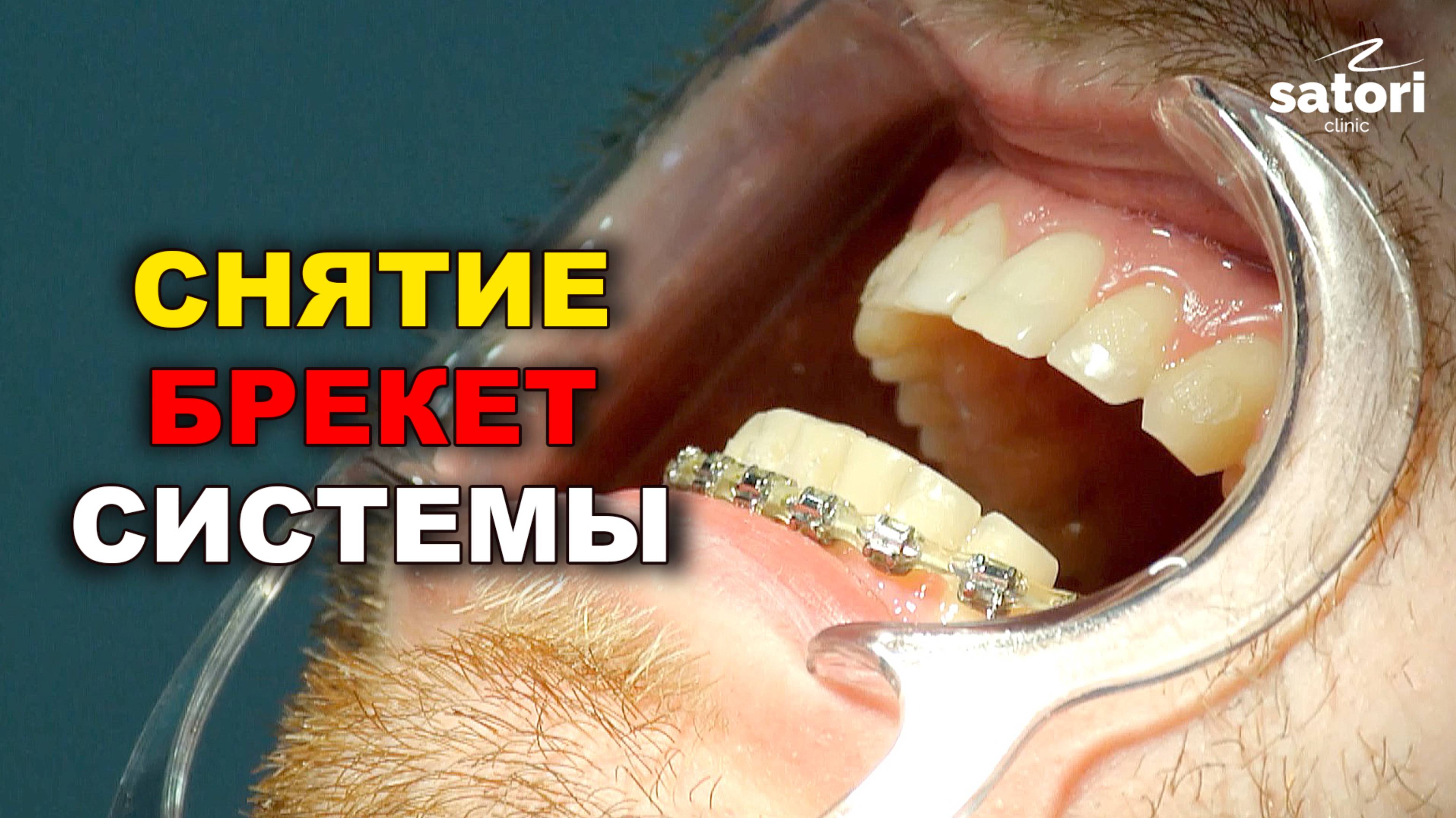 Снятие брекет-системы спустя 2 года лечения смотреть онлайн