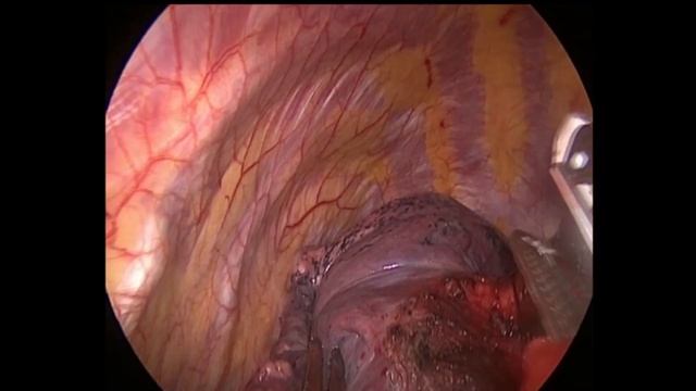Subxiphoid vats uniportal left lower lobectomy and lymph node dissection смотреть онлайн