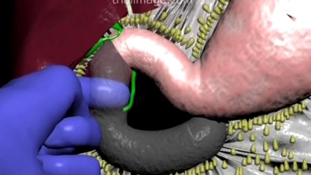 Kocher Maneuver (in 2 minutes) Animation by Cal Shipley, M.D. смотреть онлайн