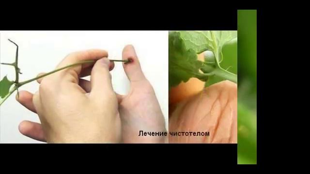 Как избавиться от бородавок навсегда.