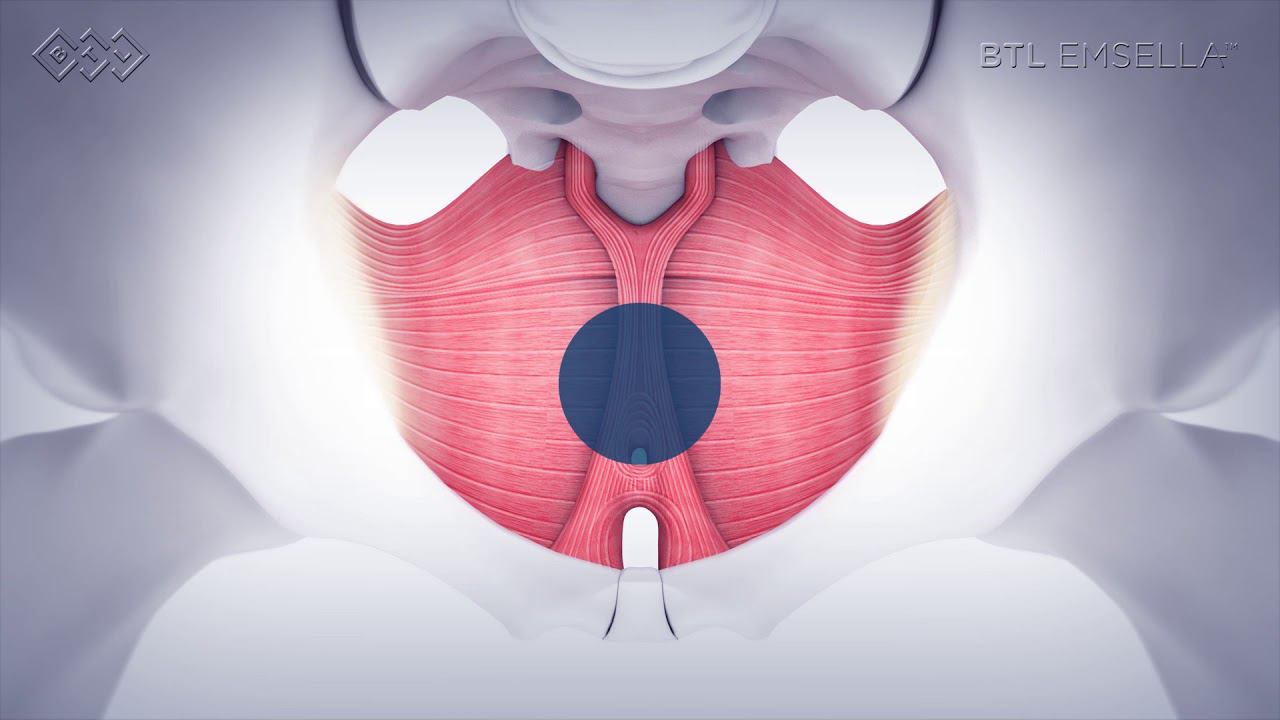 BTL Emsella market release video RU смотреть онлайн