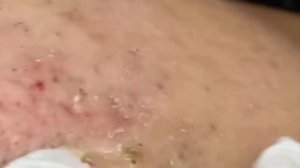 Удаление черных точек 2022 EP14