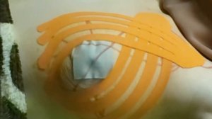 Эстетическое тейпирование груди при птозе и растяжках