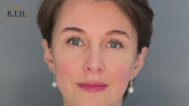 Круговая блефароластика. Результат.