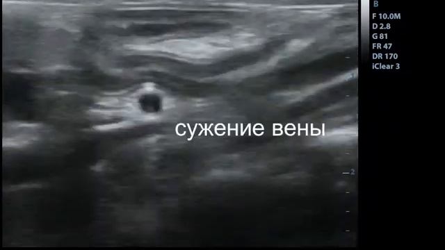 Сужение воротной вены смотреть онлайн