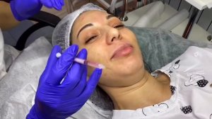 Растворяем излишки филера гиалуронидазой .