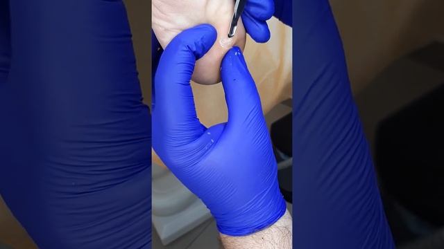 Обработка подошвенной бородавки ч.1 смотреть онлайн